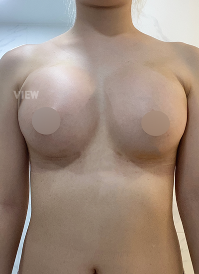 pain after breast surgery