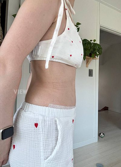 south korea tummy tuck
