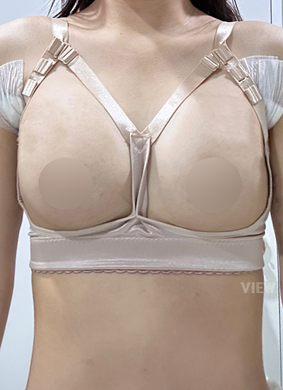 This is my recovery review, day 3 after breast augmentation surgery at View.