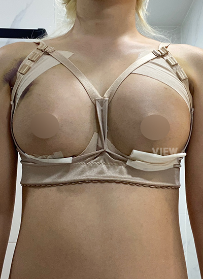 3 days after breast surgery