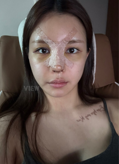 Day 3 After Rhinoplasty in Korea: