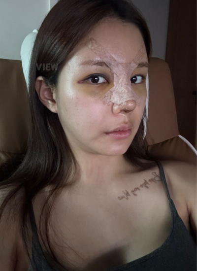 Swelling and Splint Update After Nose Surgery