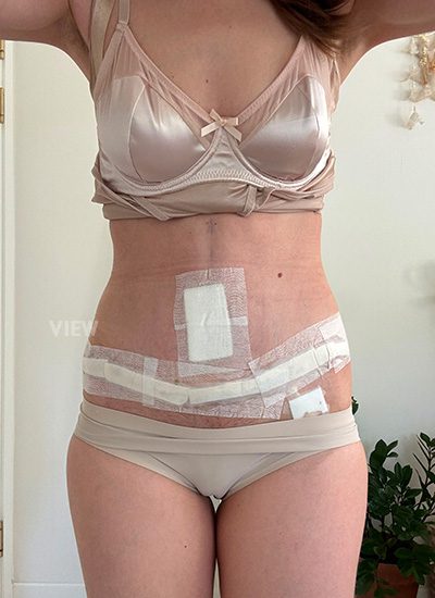 tummy tuck recovery