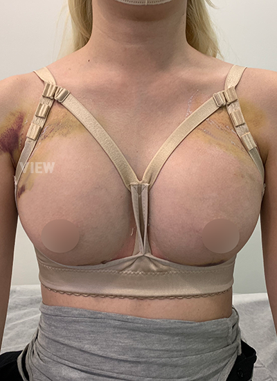 1 week after breast surgery