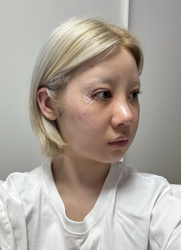 I came across VIEW Plastic Surgery while researching revision eye surgery, canthoplasty, and rhinoplasty in Seoul.