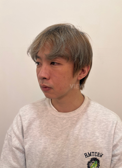 1 week after under eye bags repositioning surgery korea