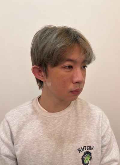 Eye Bag Surgery Recovery Timeline