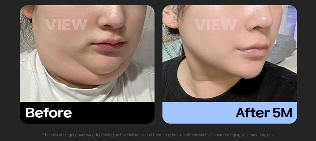 Double Chin Liposuction Before After 03