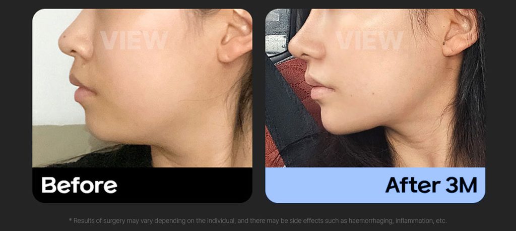 Double Chin Liposuction Before After 01