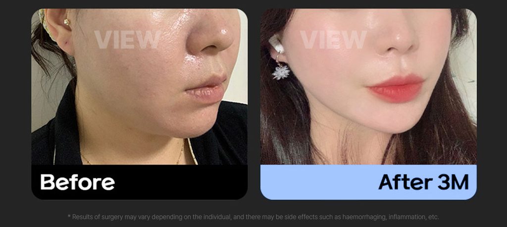 Double Chin Liposuction Before After 02