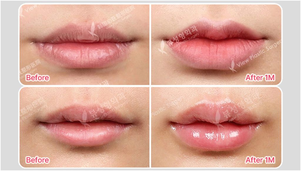 VIEW Plastic Surgery Lip Filler Before & After