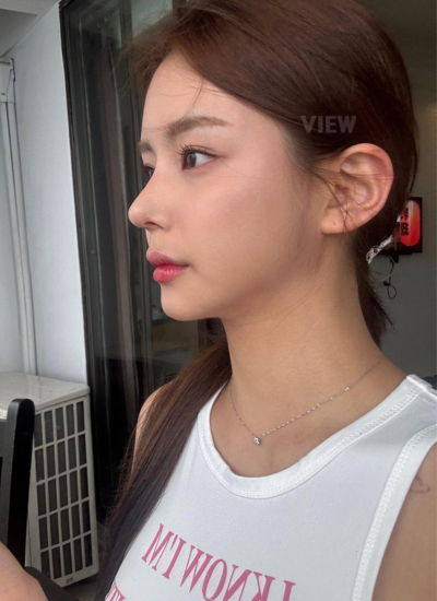 1 Month Rhinoplasty Recovery in Korea