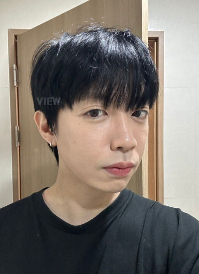 Swelling after eye bag surgery