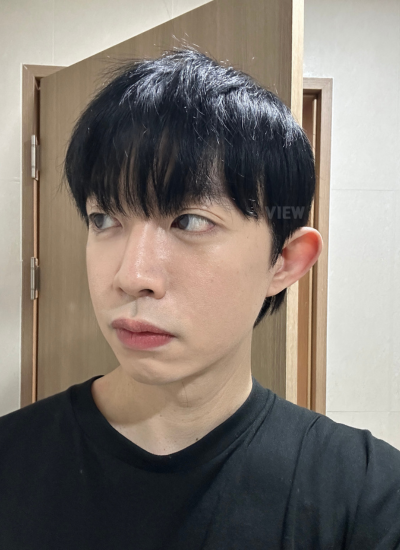 One Month After Under Eye Fat Repositioning Surgery