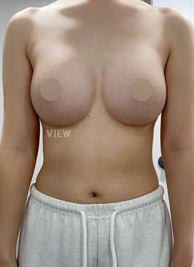Breast surgery experts in Korea