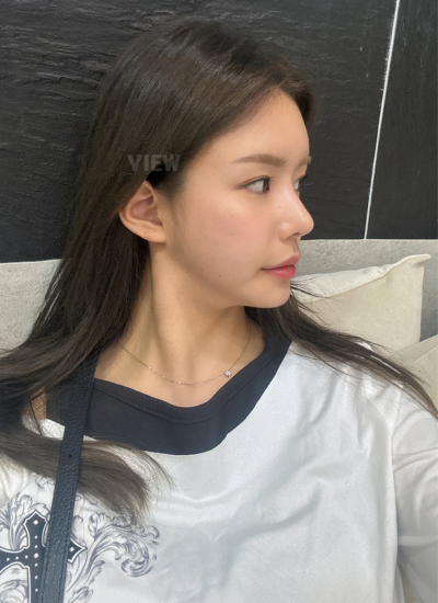 3 Months Rhinoplasty Results at View Plastic Surgery