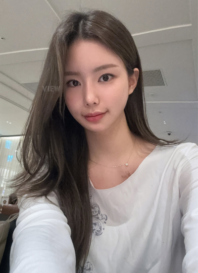 3 Months Rhinoplasty Results in Korea