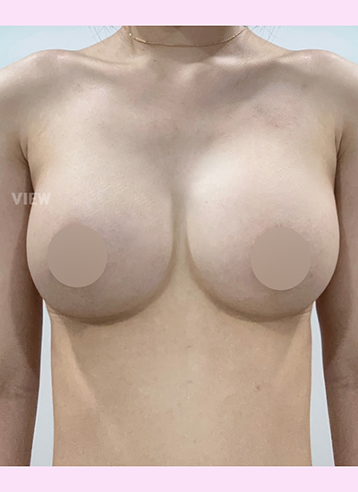 4 Months Update Korean Breast Augmentation Journey