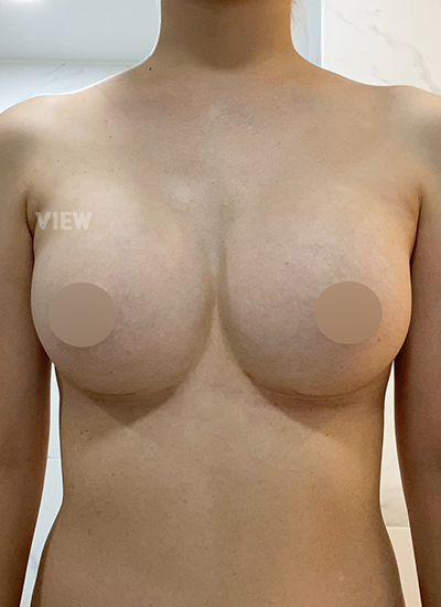  Lower body workouts after breast surgery
