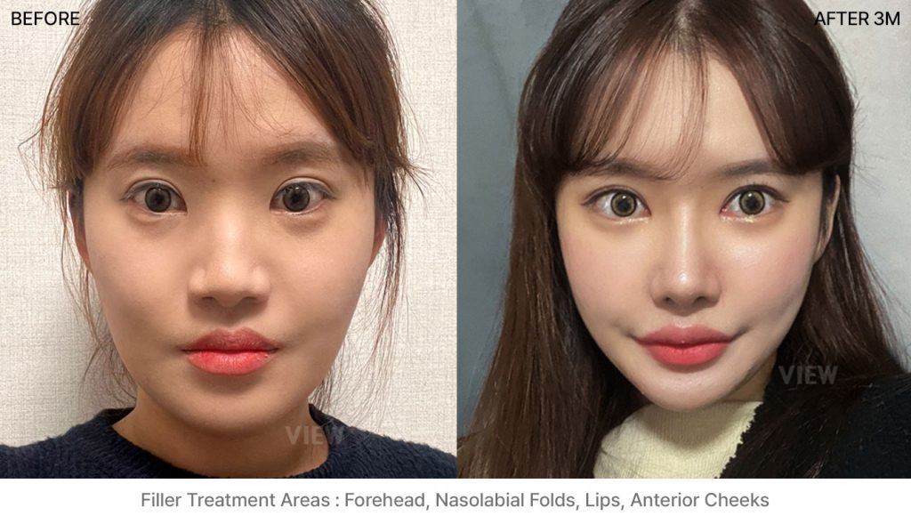 Dermal Fillers Seoul: Clinical Guide to Types & Results