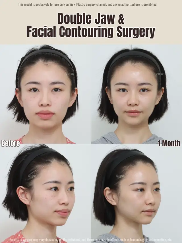 Copyrights to images and all other materials related to this content belong to VIEW and you may be liable for unauthorized distribution and or reproduction of the same without written consent. #korea #plasticsurgery #glowup #gangnam #winter