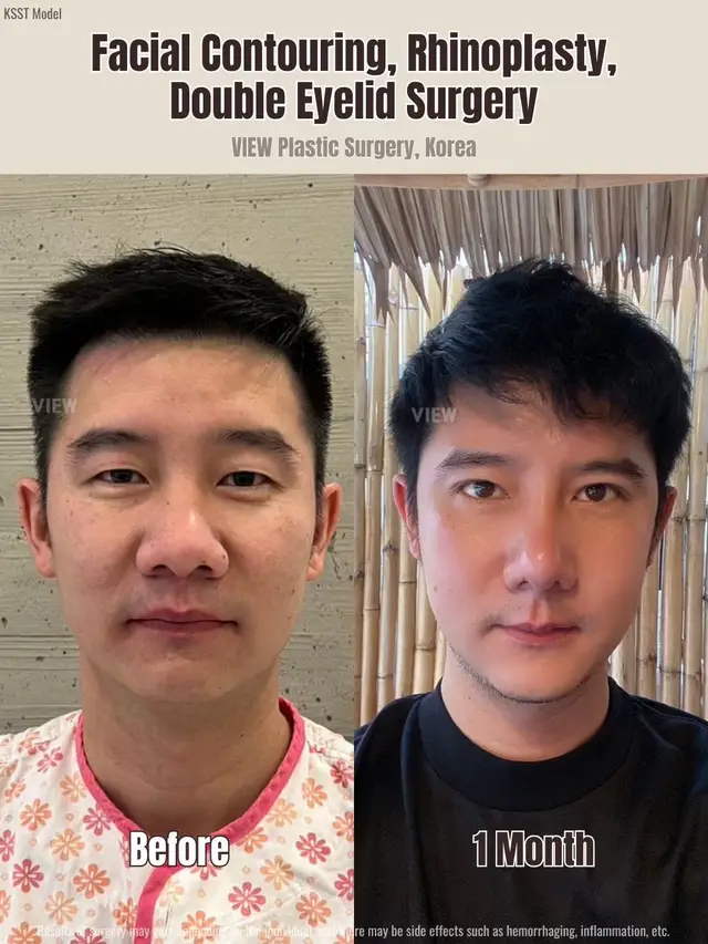 Copyrights to images and all other materials related to this content belong to VIEW and you may be liable for unauthorized distribution and or reproduction of the same without written consent. #korea #plasticsurgery #spiderman #sehun #kpop