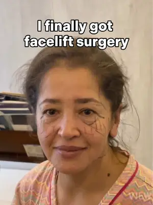 I finally got facelift in Korea Copyrights to images and all other materials related to this content belong to VIEW and you may be liable for unauthorized distribution and or reproduction of the same without written consent. #korea #lindsaylohan #annehathaway #facelift #guadalajara