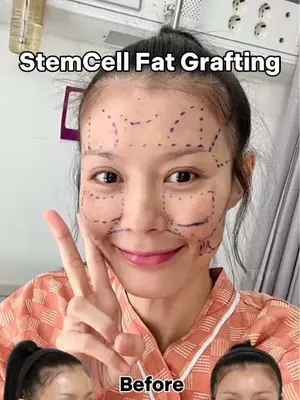 StemCell Fat Grafting in Korea Copyrights to images and all other materials related to this content belong to VIEW and you may be liable for unauthorized distribution and or reproduction of the same without written consent. #korea #kbeauty #bigbang #makeup #meovv