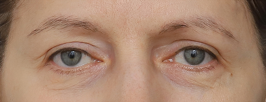 Eye Before