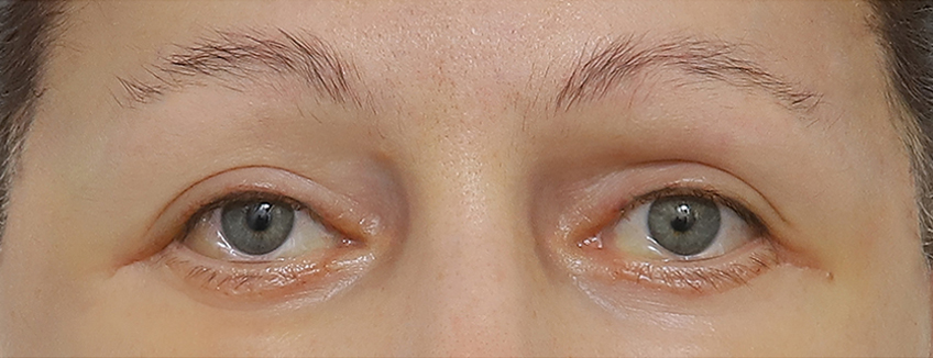 Eye After