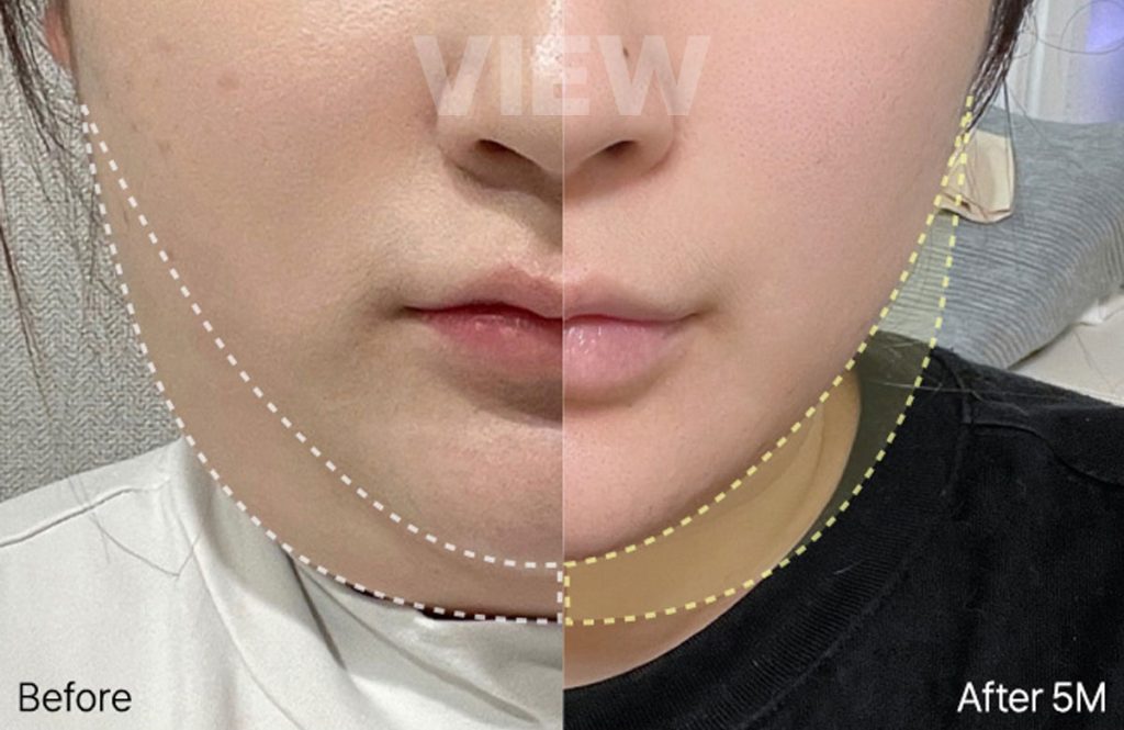 Double Chin Liposuction in Korea: Ultimate Sharp V-Line Guide