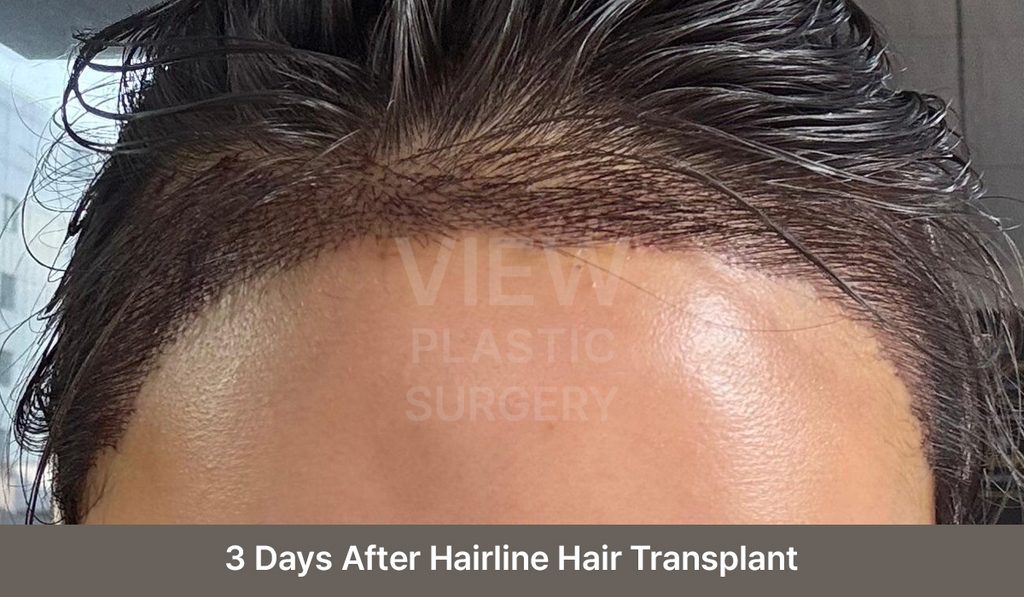 3 Days After Hairline Hair Transplant