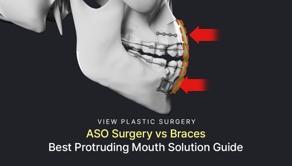 ASO Surgery vs Braces: Best Protruding Mouth Solution Guide