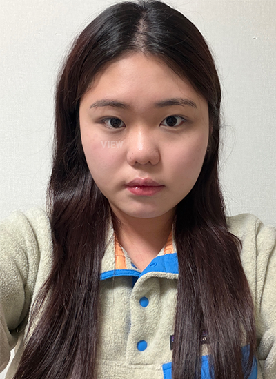 mini rhinoplasty