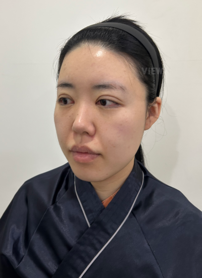 Before face liposuction in Korea