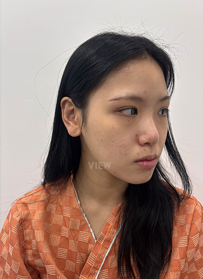8 Months After My Rhinoplasty in Korea at View Plastic Surgery