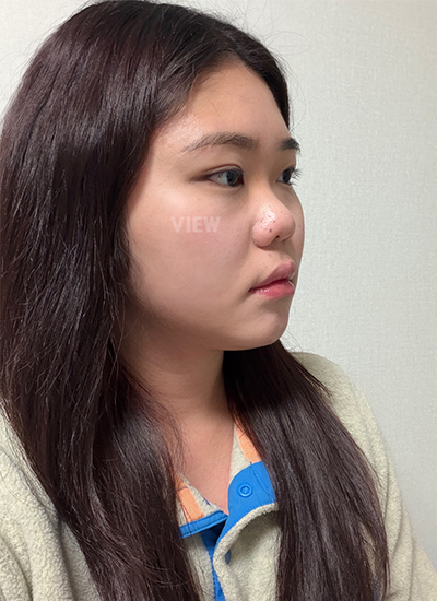 Pointy but natural nose surgery