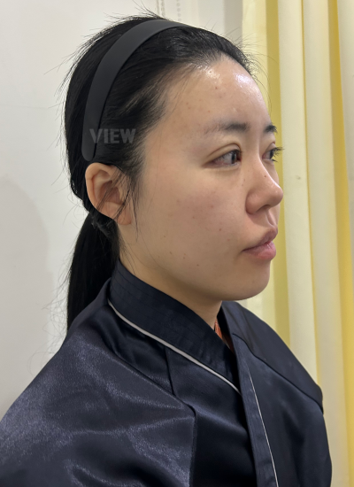 Face Liposuction in Korea Review