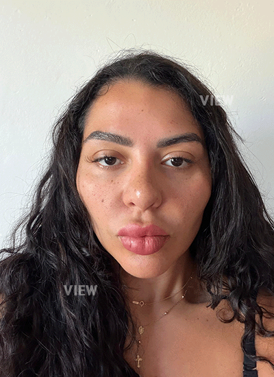 Nose Job in Korea