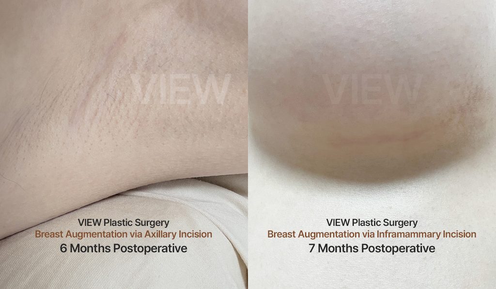 Breast Augmentation Incision Scars