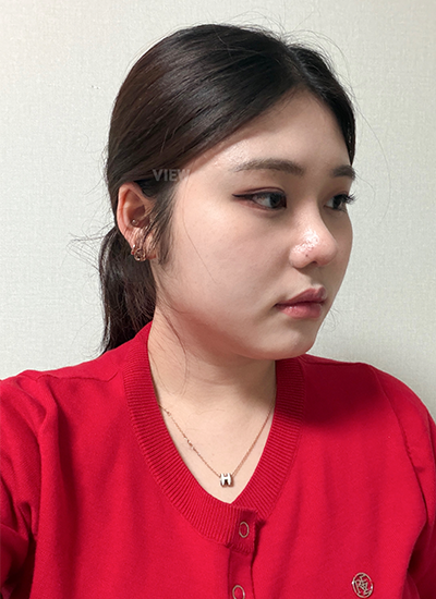 Two Weeks Post Plastic Surgery in Korea
