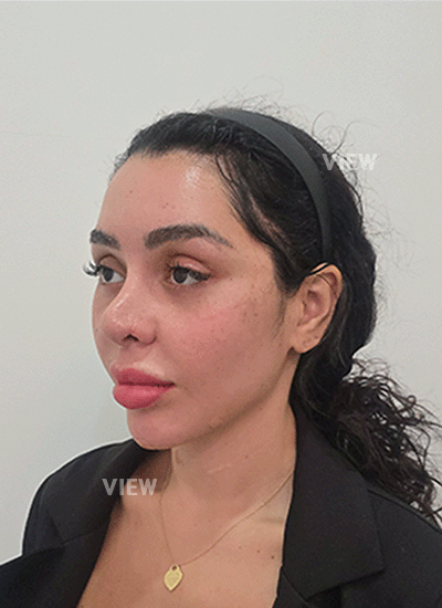 Revision rhinoplasty at VIEW Plastic Surgery in Korea