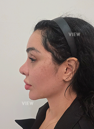 2 Weeks Post Rhinoplasty in Seoul: Flying Home & Results