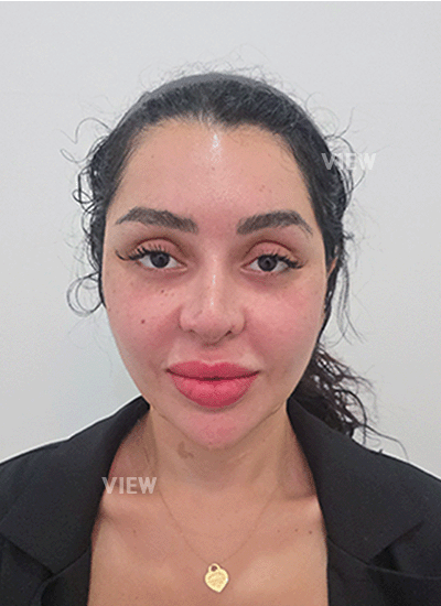 Results after nose surgery in Korea