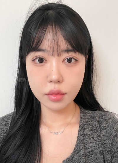 2 Weeks After Face Liposuction Korea