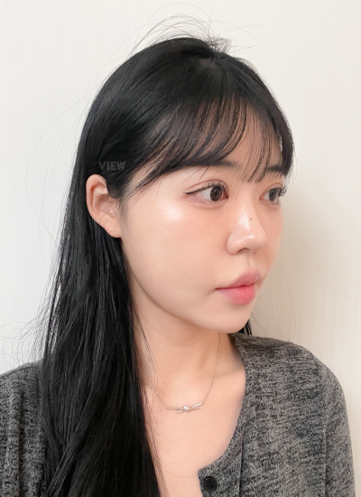 Swelling after face liposuction
