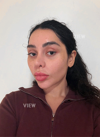 Nose healing after nose job