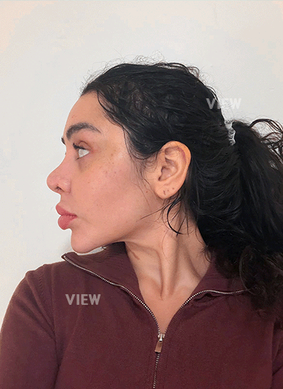 3 Weeks After Nose Job in Korea: Back to My Routine