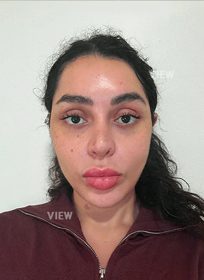 I couldn't be happier with my rhinoplasty in Korea