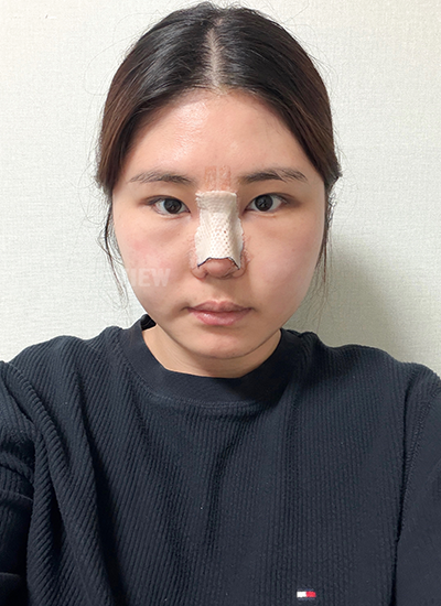 Day 3 After Rhinoplasty in Korea